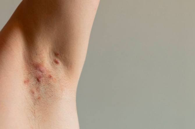 Hidradenitis Suppurativa