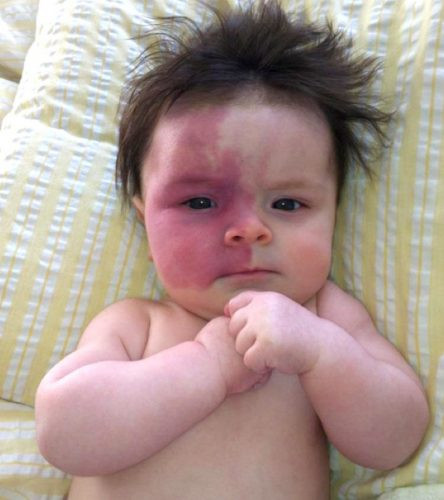 Malformasi Limfatik, Kapiler, dan Vaskular Kombinasi