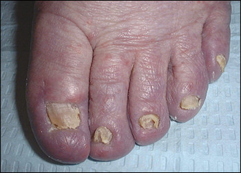 Onikomikosis (Tinea Unguium)