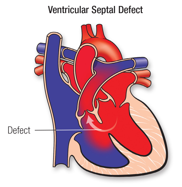 Ventricular Septal Defect