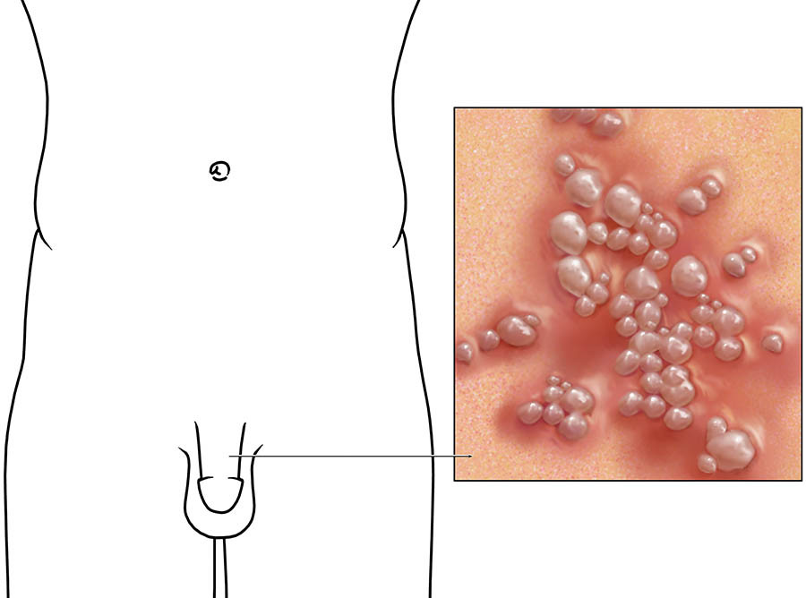 Herpes Genital pada Pria