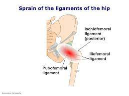 Lesi Ligamen pada Panggul (Hip Sprain)