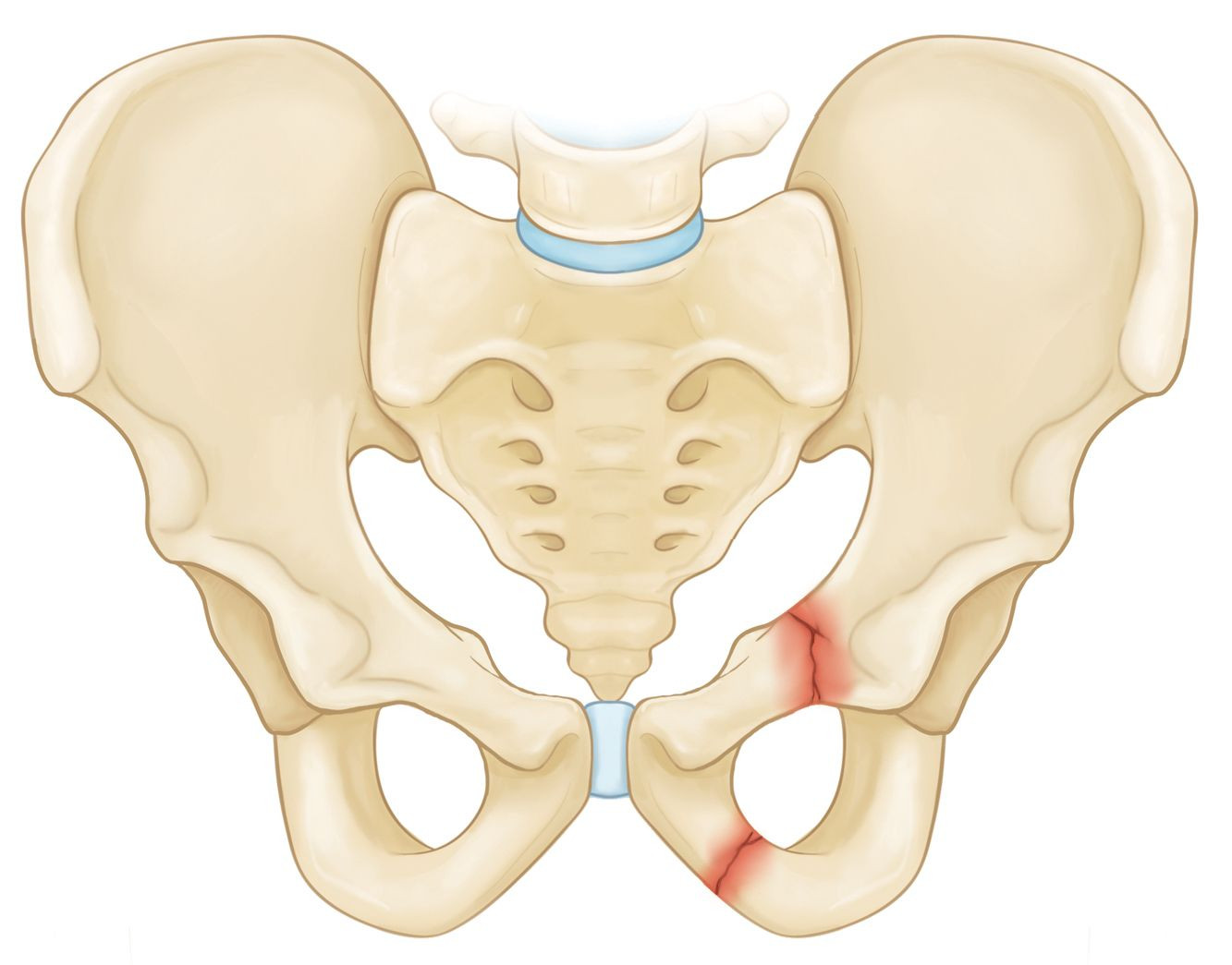 Trauma Tumpul Pelvis