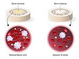Anemia Aplastik