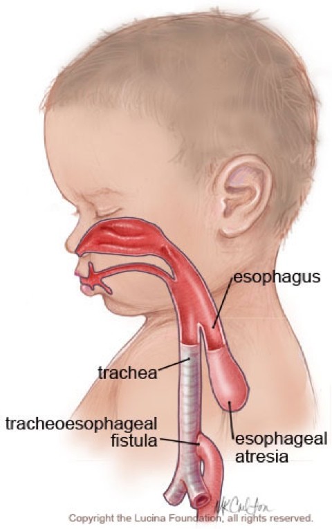 Atresia Esofagus