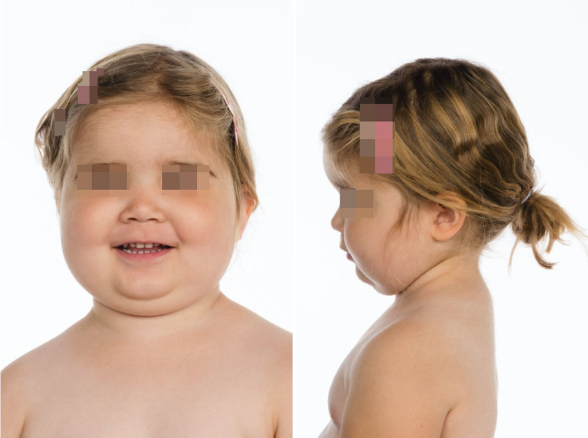 Penyakit Cushing pada Anak