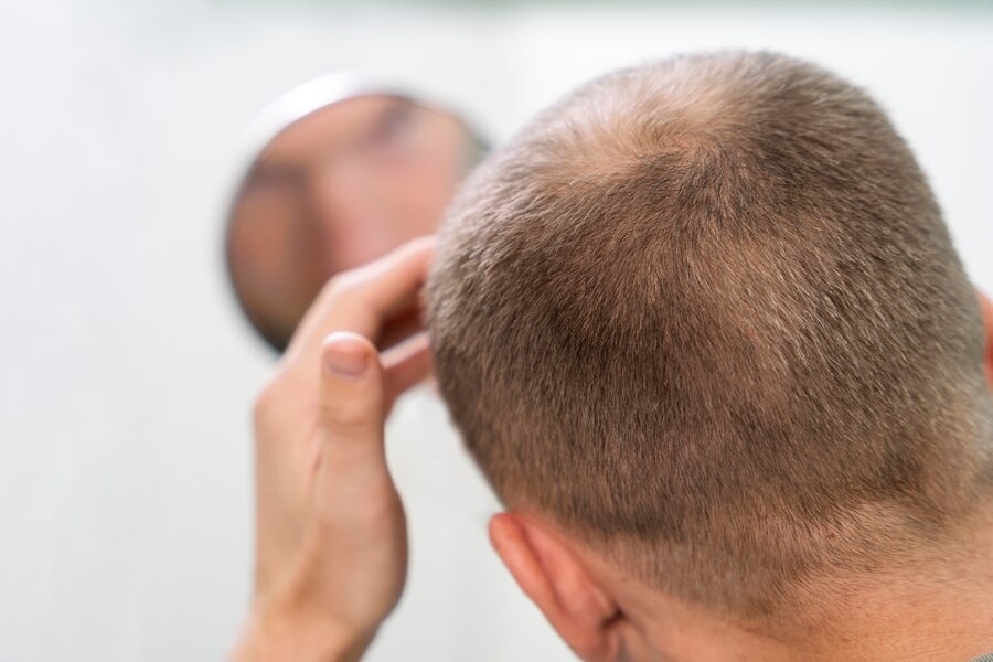 Androgenic Alopecia Vs Alopecia Areata, Apa Bedanya?